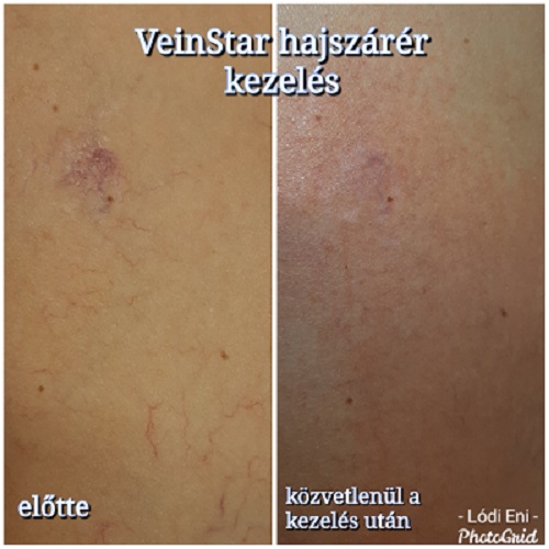 lézer carbon peeling carbonpeeling dermaroller rosacea veinstar dunakeszi göd fót vác újpest tetoválás eltávolítás férfi intimgyanta szempilla lifting szempilla dauer kozmetikus kozmetika