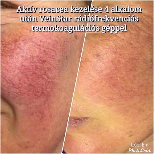 lézer carbon peeling carbonpeeling dermaroller rosacea veinstar dunakeszi göd fót vác újpest tetoválás eltávolítás férfi intimgyanta szempilla lifting szempilla dauer kozmetikus kozmetika