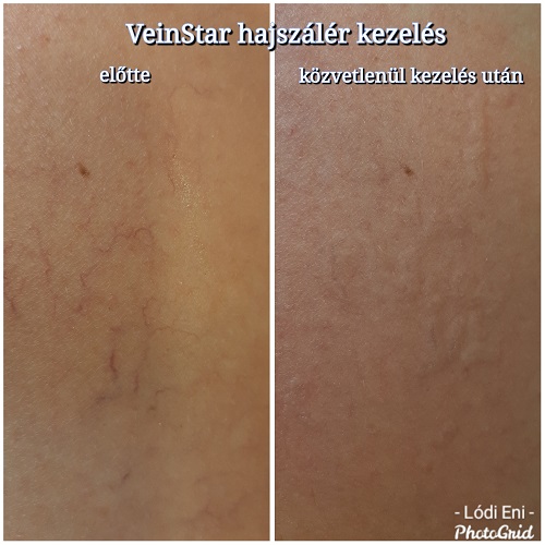 lézer carbon peeling carbonpeeling dermaroller rosacea veinstar dunakeszi göd fót vác újpest tetoválás eltávolítás férfi intimgyanta szempilla lifting szempilla dauer kozmetikus kozmetika